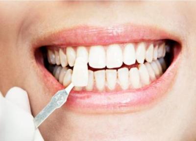 اطلاعاتی راجع به کامپوزیت دندانی
