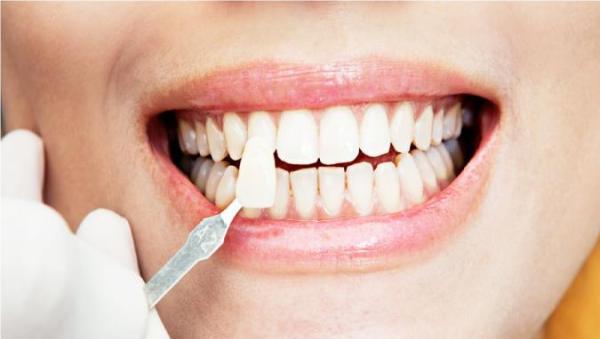 اطلاعاتی راجع به کامپوزیت دندانی